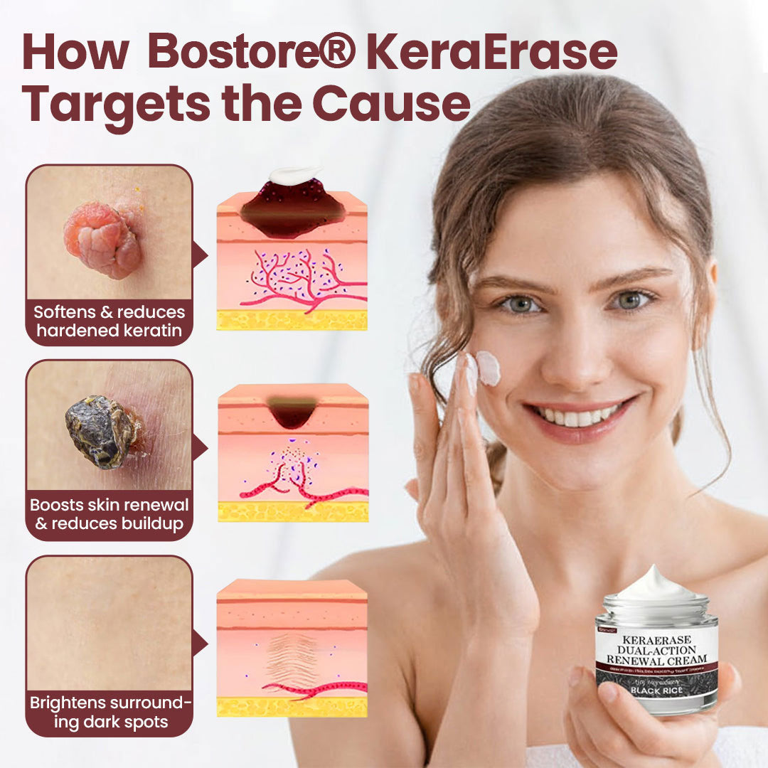 𝐎𝐟𝐟𝐢𝐜𝐢𝐚𝐥 𝐒𝐭𝐨𝐫𝐞 |Bostore® KeraErase Dual-Action Renewal Cream (Quick and painless removal of warts, moles, age spots, and skin tags with no side effects) 🎉