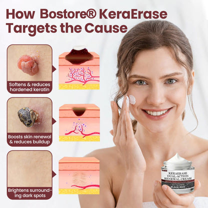 𝐎𝐟𝐟𝐢𝐜𝐢𝐚𝐥 𝐒𝐭𝐨𝐫𝐞 |Bostore® KeraErase Dual-Action Renewal Cream (Quick and painless removal of warts, moles, age spots, and skin tags with no side effects) 🎉