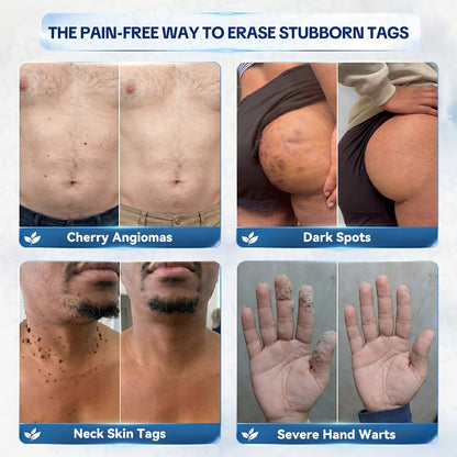 𝐏𝐢𝐜𝐝𝐨® 7-𝐃𝐚𝐲 𝐒𝐤𝐢𝐧 𝐓𝐚𝐠 & 𝐒𝐩𝐨𝐭 𝐄𝐫𝐚𝐬𝐞𝐫 𝐂𝐫𝐞𝐚𝐦 (Zero Pain, Zero 𝐒𝐜𝐚𝐫𝐬 Formula) 🌹