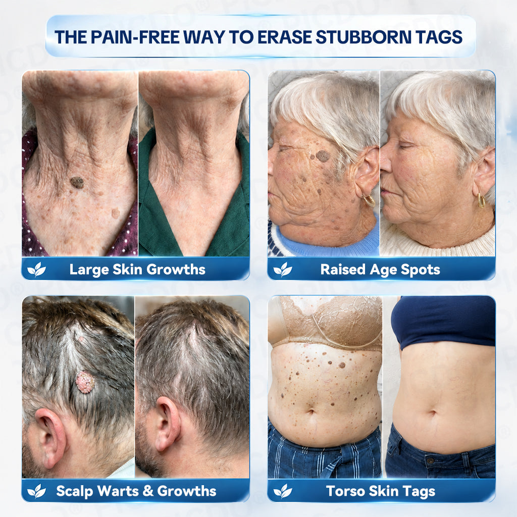 𝐏𝐢𝐜𝐝𝐨® 7-𝐃𝐚𝐲 𝐒𝐤𝐢𝐧 𝐓𝐚𝐠 & 𝐒𝐩𝐨𝐭 𝐄𝐫𝐚𝐬𝐞𝐫 𝐂𝐫𝐞𝐚𝐦 (Zero Pain, Zero 𝐒𝐜𝐚𝐫𝐬 Formula) 🌹