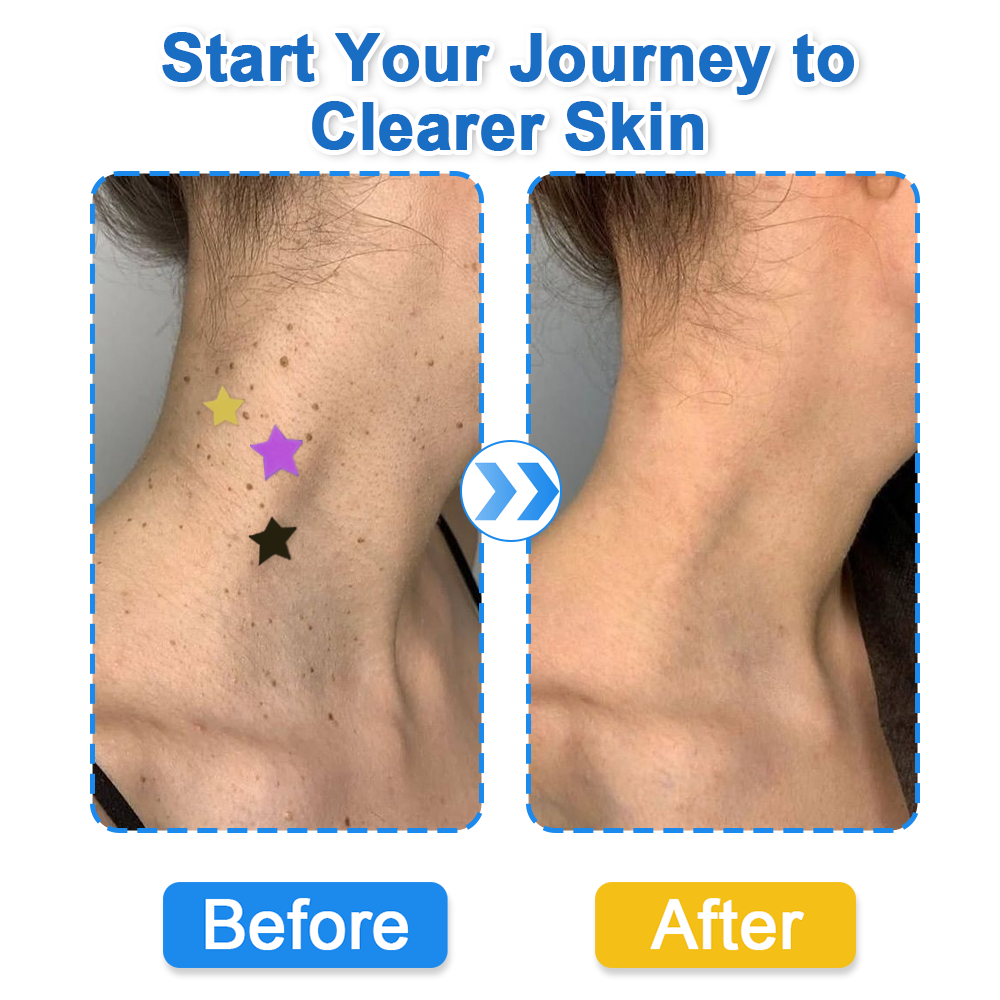 🌟Bostore® Star Pimple Patches: 2-in-1 Microneedle & Hydrocolloid Zit Stickers (6 Colors)
