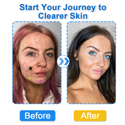 🌟Bostore® Star Pimple Patches: 2-in-1 Microneedle & Hydrocolloid Zit Stickers (6 Colors)