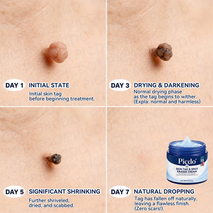 𝐏𝐢𝐜𝐝𝐨® 7-𝐃𝐚𝐲 𝐒𝐤𝐢𝐧 𝐓𝐚𝐠 & 𝐒𝐩𝐨𝐭 𝐄𝐫𝐚𝐬𝐞𝐫 𝐂𝐫𝐞𝐚𝐦 (Zero Pain, Zero 𝐒𝐜𝐚𝐫𝐬 Formula) 🌹