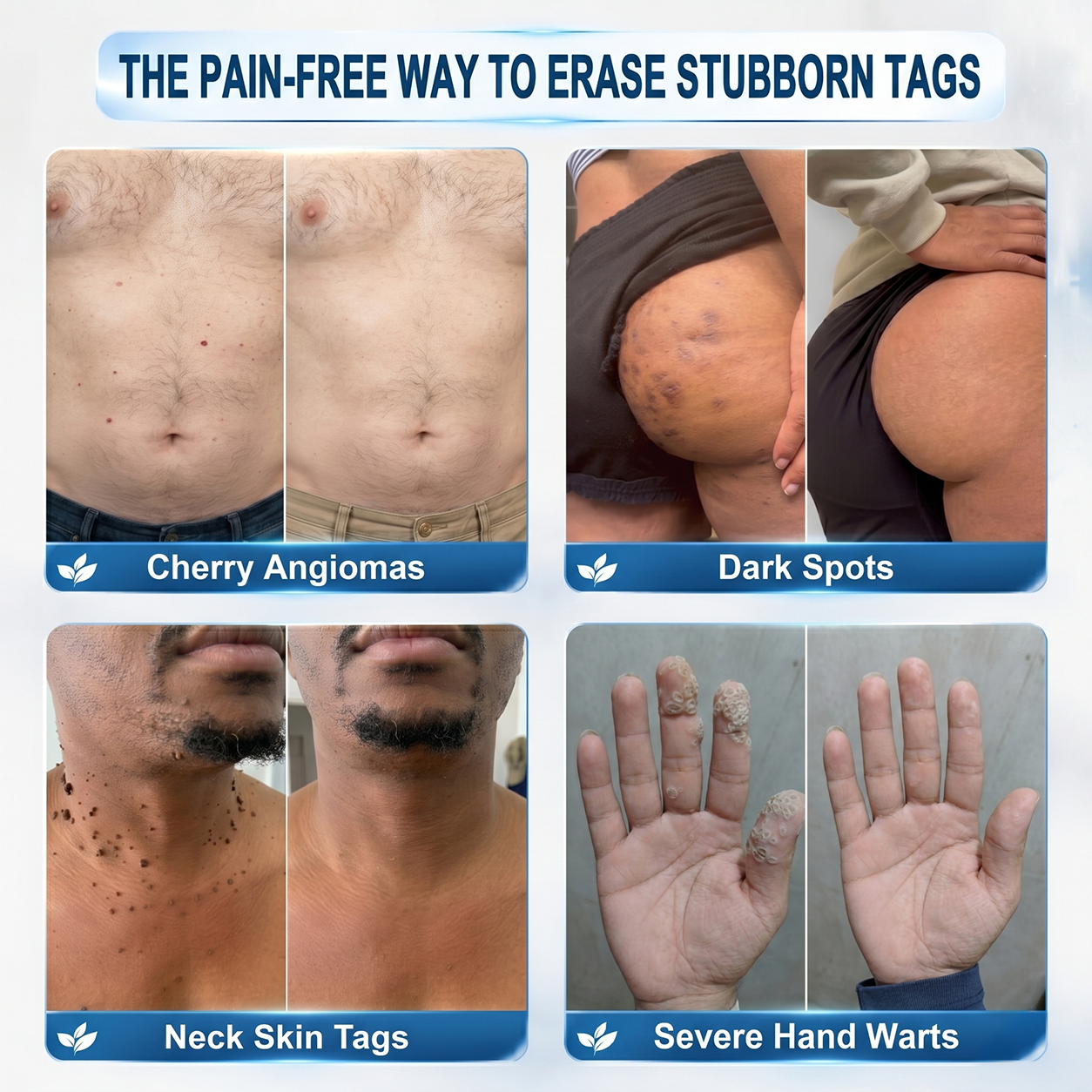 𝐏𝗂𝖼𝐝𝗈® 𝟳-𝗗𝗮𝘆 𝐑𝗼𝗹𝗹𝗲𝗿 𝐀𝗽𝗽𝗹𝗶𝗰𝗮𝘁𝗼𝗿 (𝐙𝗲𝗿𝗼 𝐏𝗮𝗶𝗻, 𝐙𝗲𝗿𝗼 𝐒𝗰𝗮𝗿𝘀 𝐑𝗼𝗹𝗹𝗲𝗿𝗯𝗮𝗹𝗹)✅𝑺𝒖𝒊𝒕𝒂𝒃𝒍𝒆 𝒇𝒐𝒓: 𝒔𝒌𝒊𝒏 𝒕𝒂𝒈𝒔, 𝒔𝒑𝒐𝒕𝒔, 𝒎𝒐𝒍𝒆𝒔, 𝒘𝒂𝒓𝒕𝒔, 𝒃𝒍𝒊𝒔𝒕𝒆𝒓𝒔, 𝒆𝒄𝒛𝒆𝒎𝒂, 𝒅𝒂𝒏𝒅𝒓𝒖𝒇𝒇, 𝒔𝒌𝒊𝒏 𝒌𝒆𝒓𝒂𝒕𝒐𝒔𝒊𝒔, 𝒂𝒄𝒏𝒆, 𝒔𝒌𝒊𝒏 𝒈𝒓𝒐𝒘𝒕𝒉𝒔, 𝒔𝒄𝒂𝒓𝒔, 𝒃𝒊𝒓𝒕𝒉𝒎𝒂𝒓𝒌𝒔 💯