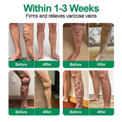 [FDA-Registered & GMP Certified]| 𝐅𝗹𝒐𝐫𝐢𝒔𝗺𝙖® 🇺🇸𝐕𝗲𝐢𝐧𝐓𝙖𝐫𝐠𝗲𝐭 𝐌𝐢𝐜𝐫𝐨𝐧𝗲𝗲𝐝𝗹𝐞 𝐏𝙖𝐭𝐜𝐡🌿Instant Relief, Long-Term Results