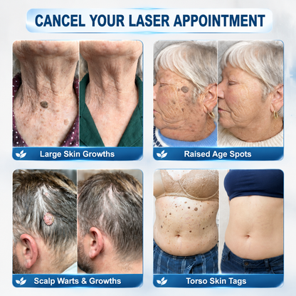 𝐏𝗂𝖼𝐝𝗈® 𝟳-𝗗𝗮𝘆 𝐑𝗼𝗹𝗹𝗲𝗿 𝐀𝗽𝗽𝗹𝗶𝗰𝗮𝘁𝗼𝗿 (𝐙𝗲𝗿𝗼 𝐏𝗮𝗶𝗻, 𝐙𝗲𝗿𝗼 𝐒𝗰𝗮𝗿𝘀 𝐑𝗼𝗹𝗹𝗲𝗿𝗯𝗮𝗹𝗹)✅𝑺𝒖𝒊𝒕𝒂𝒃𝒍𝒆 𝒇𝒐𝒓: 𝒔𝒌𝒊𝒏 𝒕𝒂𝒈𝒔, 𝒔𝒑𝒐𝒕𝒔, 𝒎𝒐𝒍𝒆𝒔, 𝒘𝒂𝒓𝒕𝒔, 𝒃𝒍𝒊𝒔𝒕𝒆𝒓𝒔, 𝒆𝒄𝒛𝒆𝒎𝒂, 𝒅𝒂𝒏𝒅𝒓𝒖𝒇𝒇, 𝒔𝒌𝒊𝒏 𝒌𝒆𝒓𝒂𝒕𝒐𝒔𝒊𝒔, 𝒂𝒄𝒏𝒆, 𝒔𝒌𝒊𝒏 𝒈𝒓𝒐𝒘𝒕𝒉𝒔, 𝒔𝒄𝒂𝒓𝒔, 𝒃𝒊𝒓𝒕𝒉𝒎𝒂𝒓𝒌𝒔 💯
