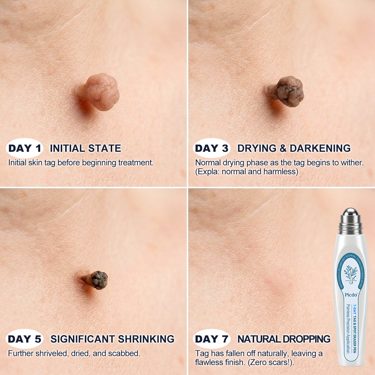 𝐏𝗂𝖼𝐝𝗈® 𝟳-𝗗𝗮𝘆 𝐑𝗼𝗹𝗹𝗲𝗿 𝐀𝗽𝗽𝗹𝗶𝗰𝗮𝘁𝗼𝗿 (𝐙𝗲𝗿𝗼 𝐏𝗮𝗶𝗻, 𝐙𝗲𝗿𝗼 𝐒𝗰𝗮𝗿𝘀 𝐑𝗼𝗹𝗹𝗲𝗿𝗯𝗮𝗹𝗹)✅𝑺𝒖𝒊𝒕𝒂𝒃𝒍𝒆 𝒇𝒐𝒓: 𝒔𝒌𝒊𝒏 𝒕𝒂𝒈𝒔, 𝒔𝒑𝒐𝒕𝒔, 𝒎𝒐𝒍𝒆𝒔, 𝒘𝒂𝒓𝒕𝒔, 𝒃𝒍𝒊𝒔𝒕𝒆𝒓𝒔, 𝒆𝒄𝒛𝒆𝒎𝒂, 𝒅𝒂𝒏𝒅𝒓𝒖𝒇𝒇, 𝒔𝒌𝒊𝒏 𝒌𝒆𝒓𝒂𝒕𝒐𝒔𝒊𝒔, 𝒂𝒄𝒏𝒆, 𝒔𝒌𝒊𝒏 𝒈𝒓𝒐𝒘𝒕𝒉𝒔, 𝒔𝒄𝒂𝒓𝒔, 𝒃𝒊𝒓𝒕𝒉𝒎𝒂𝒓𝒌𝒔 💯