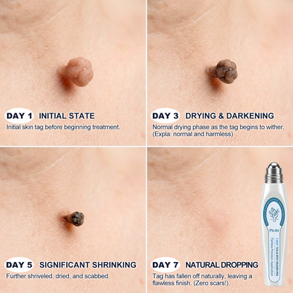 𝐏𝗂𝖼𝐝𝗈® 𝟳-𝗗𝗮𝘆 𝐑𝗼𝗹𝗹𝗲𝗿 𝐀𝗽𝗽𝗹𝗶𝗰𝗮𝘁𝗼𝗿 (𝐙𝗲𝗿𝗼 𝐏𝗮𝗶𝗻, 𝐙𝗲𝗿𝗼 𝐒𝗰𝗮𝗿𝘀 𝐑𝗼𝗹𝗹𝗲𝗿𝗯𝗮𝗹𝗹)✅𝑺𝒖𝒊𝒕𝒂𝒃𝒍𝒆 𝒇𝒐𝒓: 𝒔𝒌𝒊𝒏 𝒕𝒂𝒈𝒔, 𝒔𝒑𝒐𝒕𝒔, 𝒎𝒐𝒍𝒆𝒔, 𝒘𝒂𝒓𝒕𝒔, 𝒃𝒍𝒊𝒔𝒕𝒆𝒓𝒔, 𝒆𝒄𝒛𝒆𝒎𝒂, 𝒅𝒂𝒏𝒅𝒓𝒖𝒇𝒇, 𝒔𝒌𝒊𝒏 𝒌𝒆𝒓𝒂𝒕𝒐𝒔𝒊𝒔, 𝒂𝒄𝒏𝒆, 𝒔𝒌𝒊𝒏 𝒈𝒓𝒐𝒘𝒕𝒉𝒔, 𝒔𝒄𝒂𝒓𝒔, 𝒃𝒊𝒓𝒕𝒉𝒎𝒂𝒓𝒌𝒔 💯